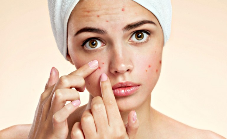 acne: rimedi contro brufoli
