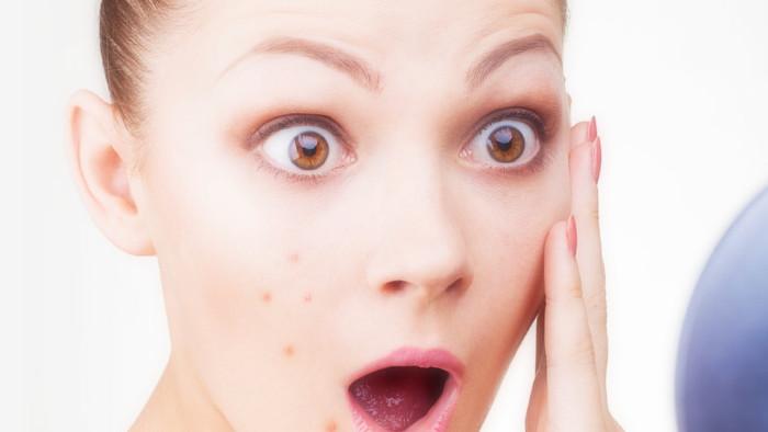 curare acne giovanile con rimedi naturali